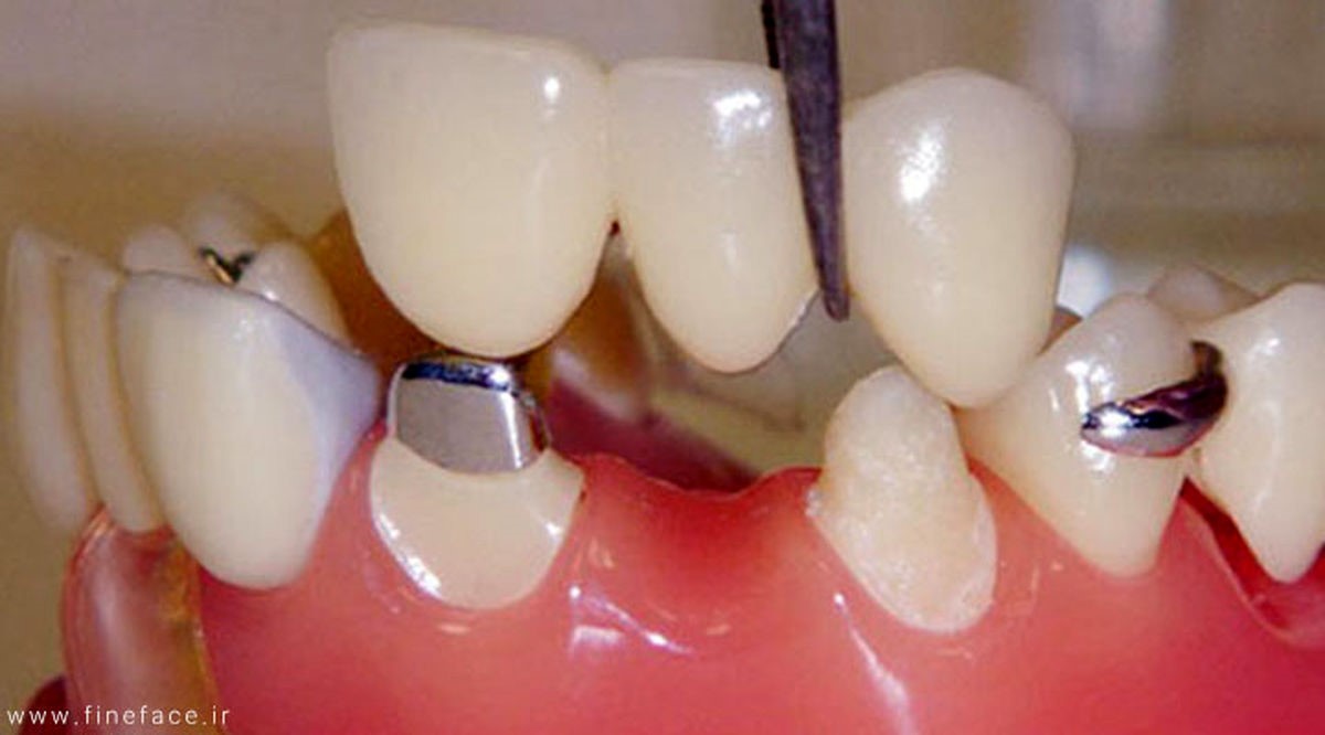 محاسن ایمپلنت دندان نسبت به بریج دندان
